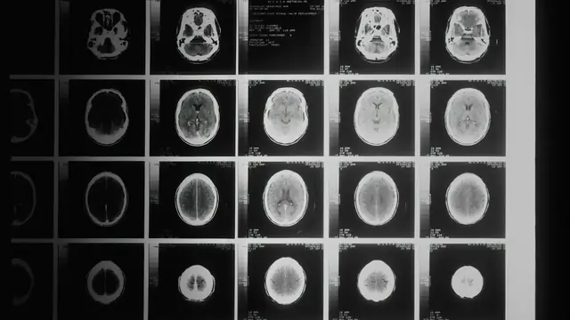 Imágenes de resonancia magnética para diagnosticar una hernia